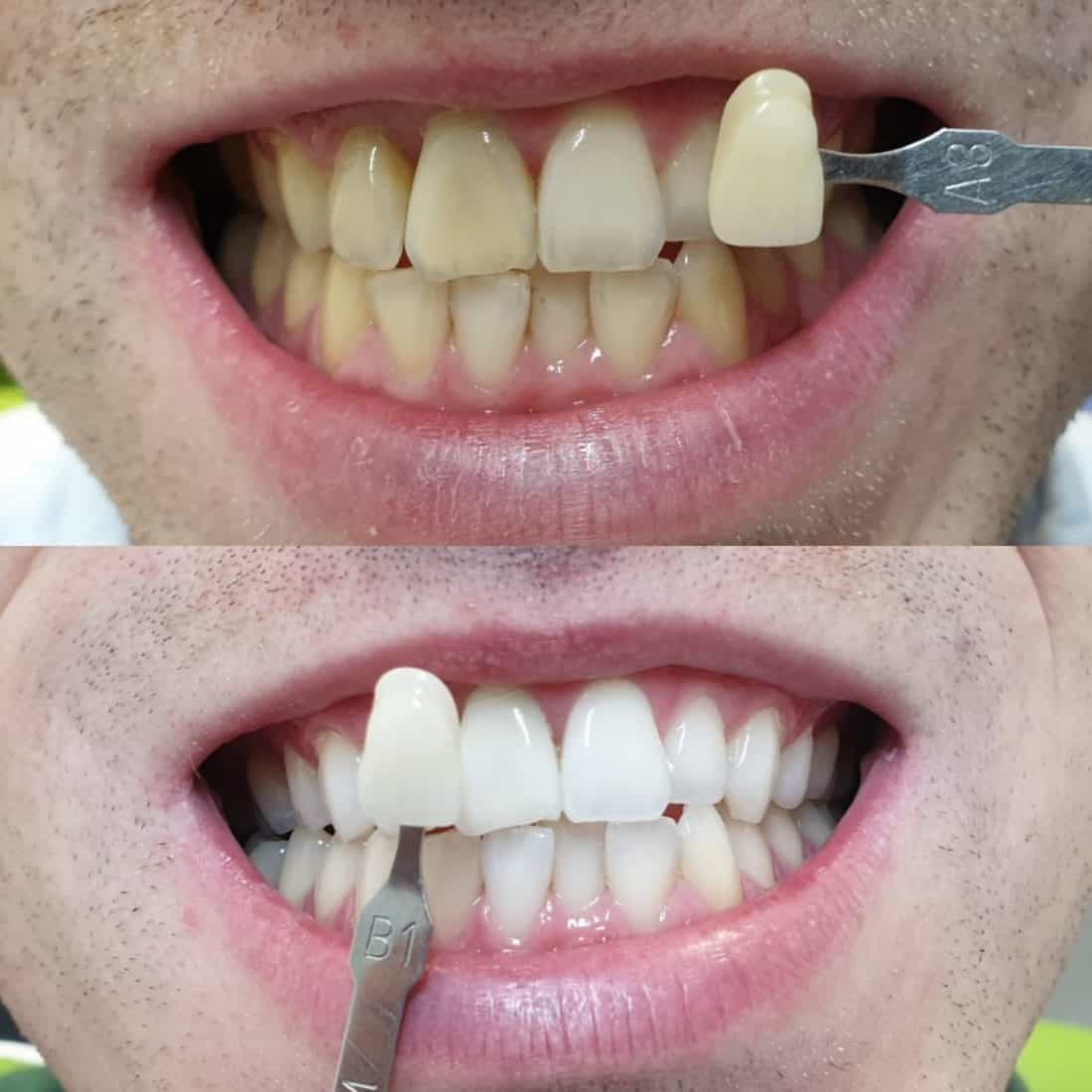 Teeth Whitening In Lincoln - Kordel House Dental Practice